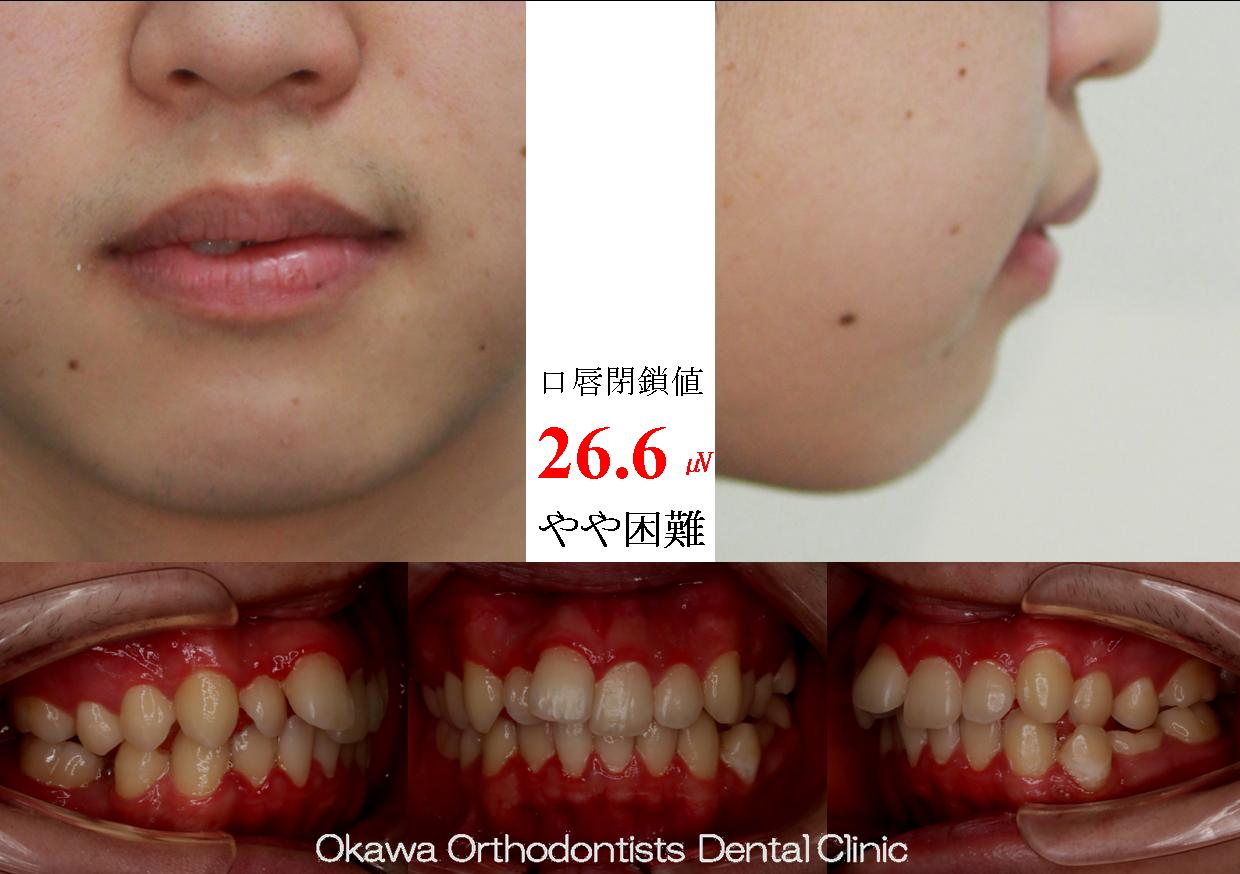 559. 先天欠如と抜歯部位の Before 画像