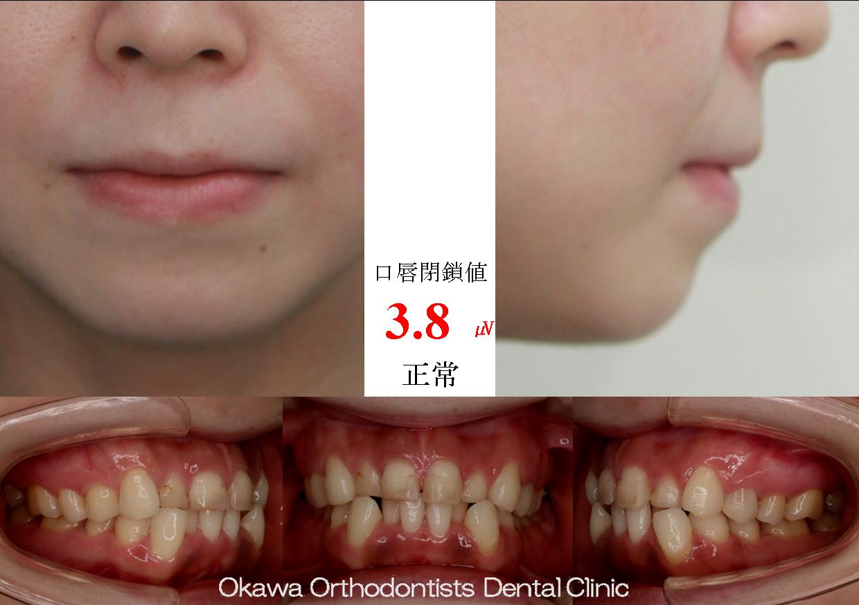 567. 叢生の典型例の Before 画像