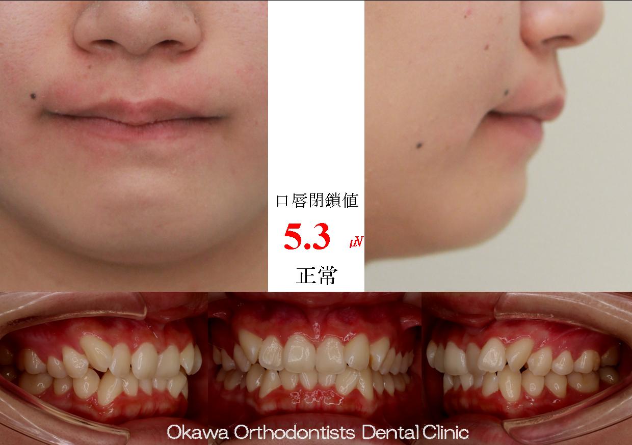 577. 前歯が舌側傾斜で叢生の Before 画像