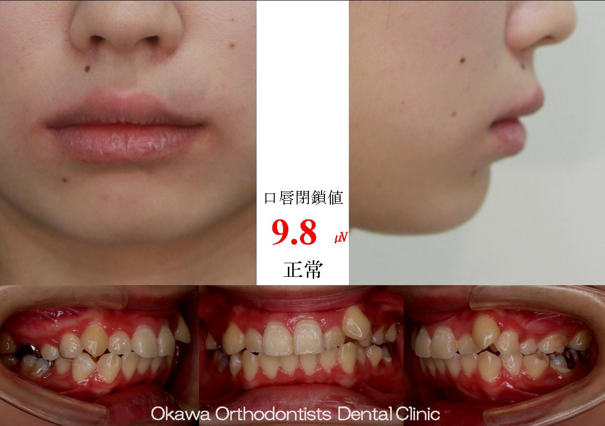 581. 第一大臼歯抜歯で智歯利用の Before 画像