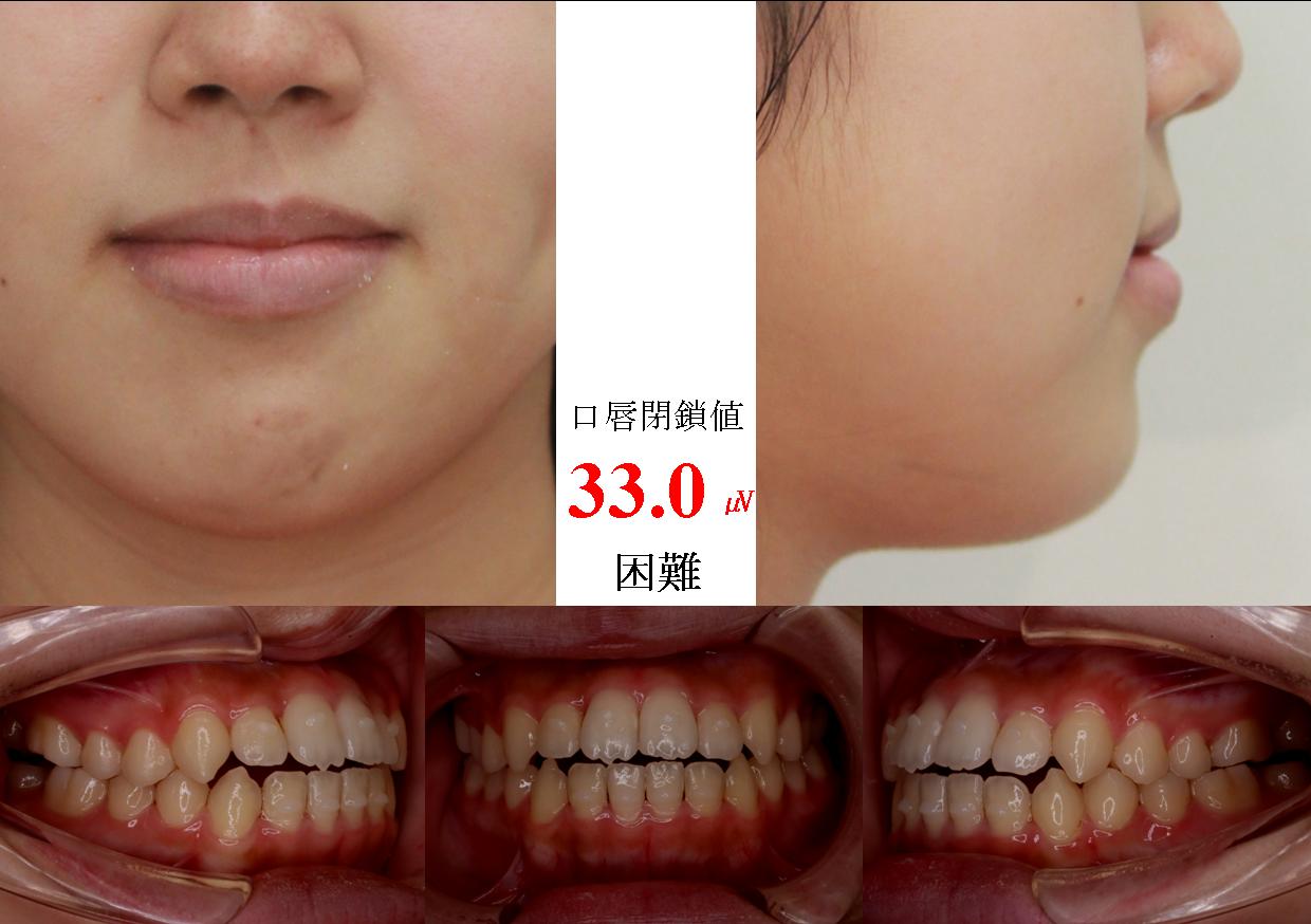 583. 安定の悪い開咬の After 画像