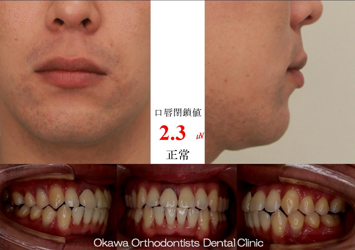 589. 側方拡大で非抜歯の After 画像