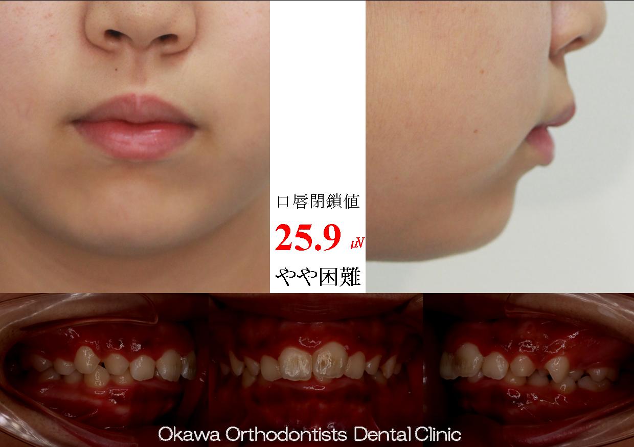 590. 非抜歯側方拡大の Before 画像