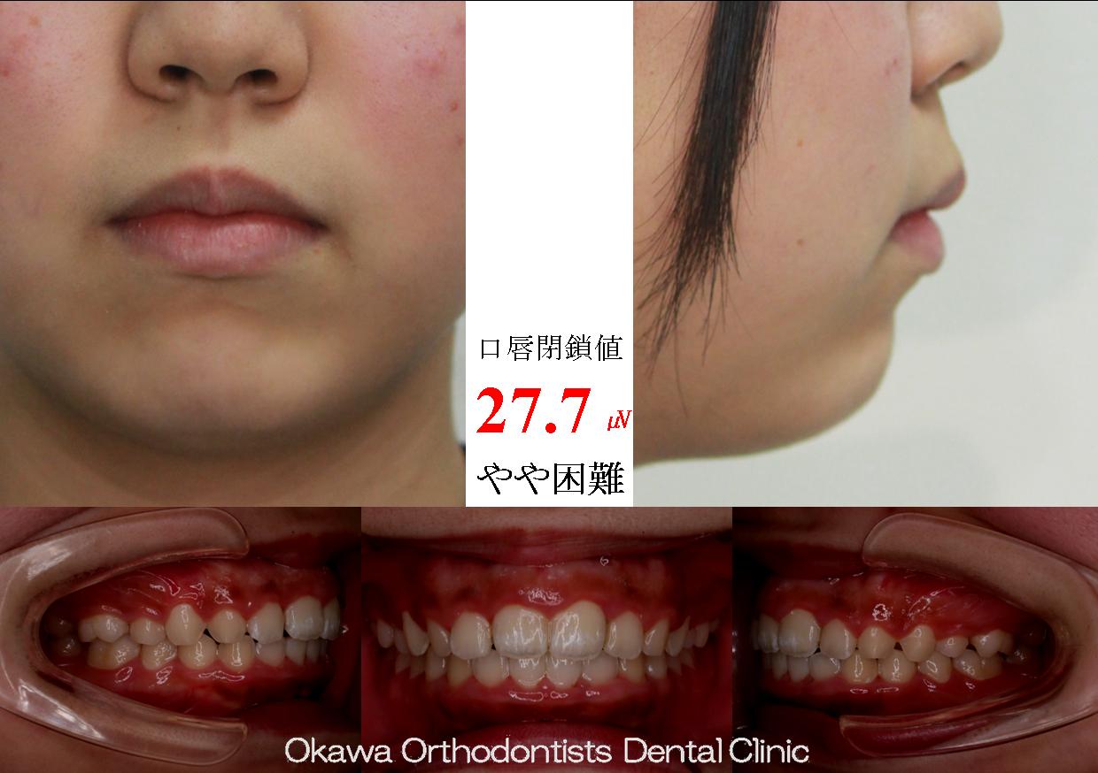 590. 非抜歯側方拡大の After 画像