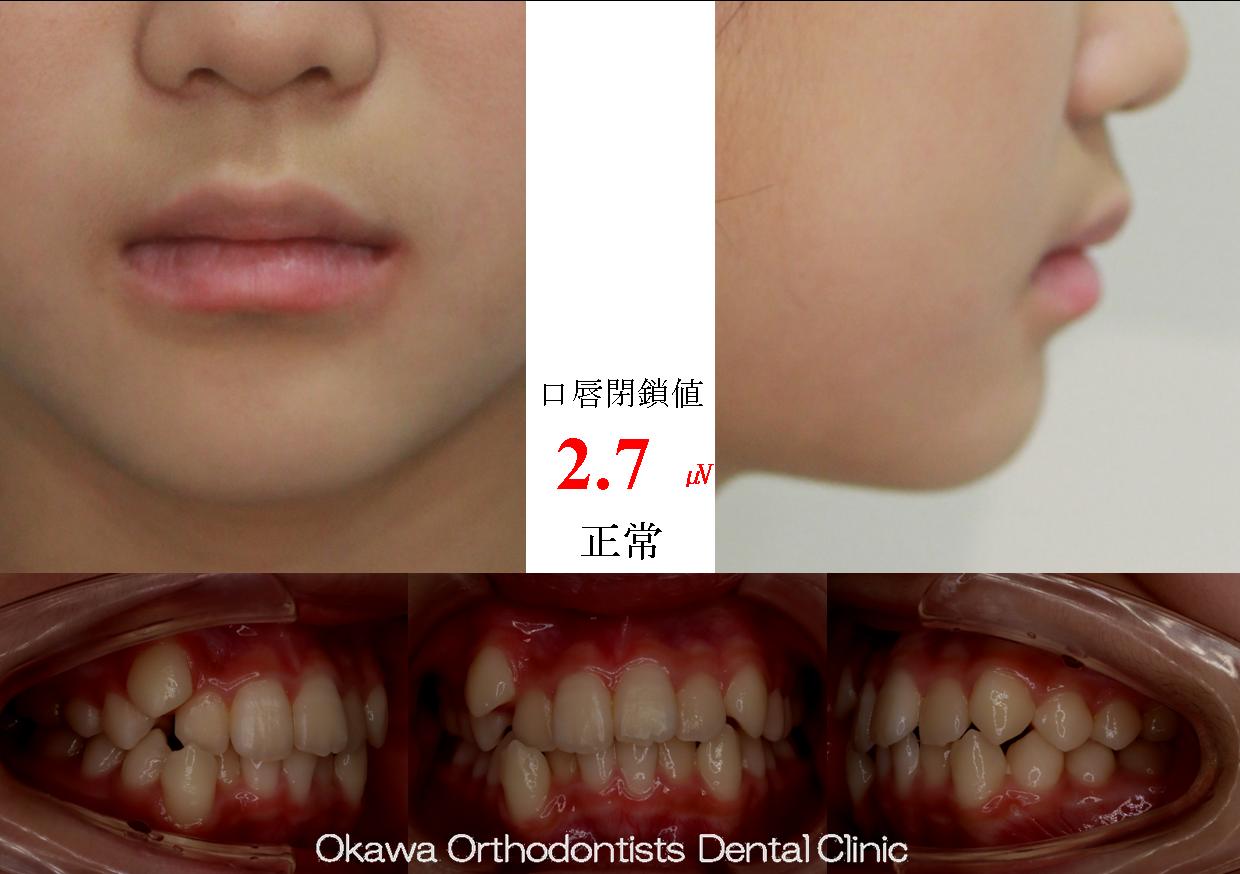 591. 抜歯しても1年余りの治療期間の Before 画像