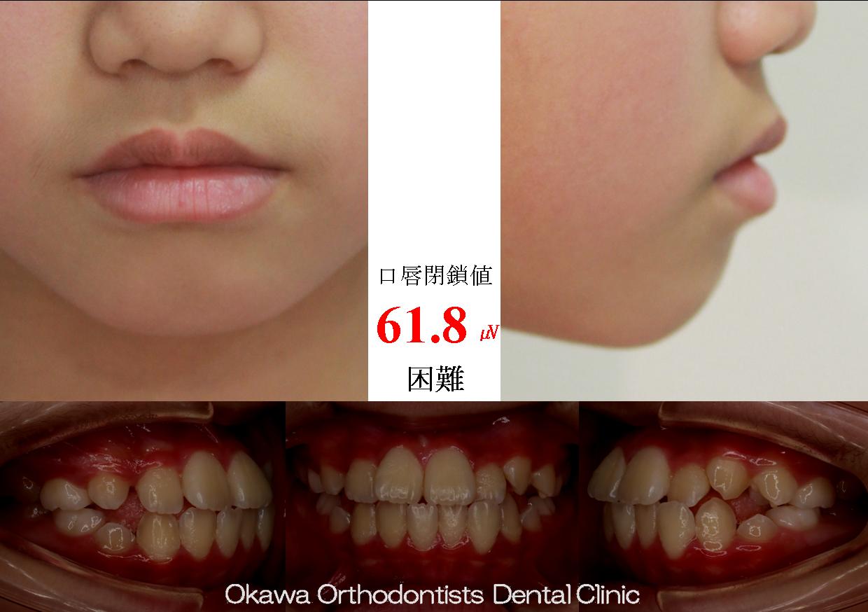 601. 埋伏歯・歯根吸収の Before 画像