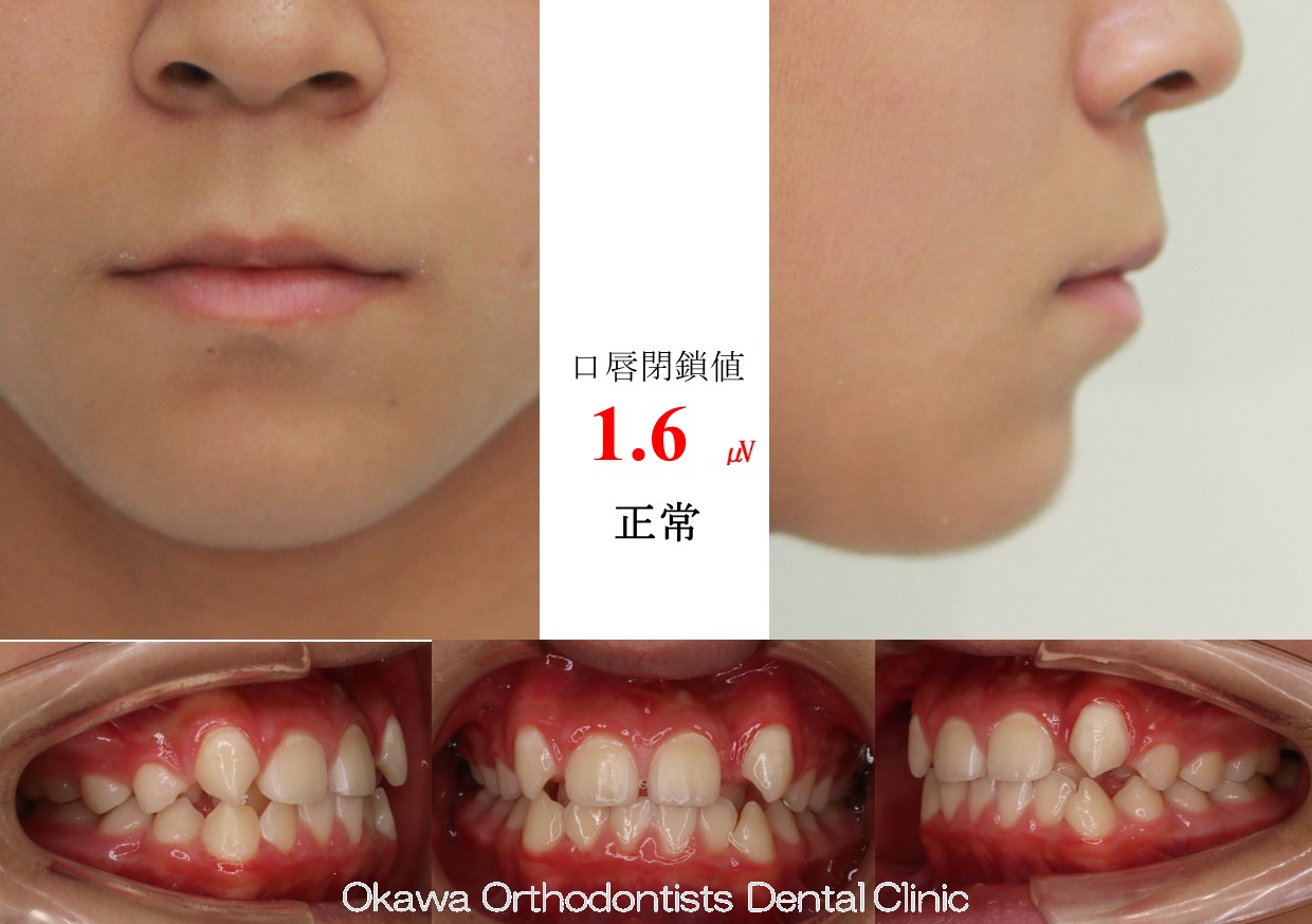 610. 治療期間が長引いたの Before 画像