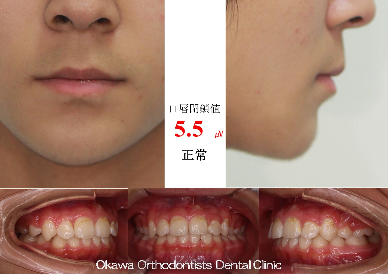 610. 治療期間が長引いたの After 画像