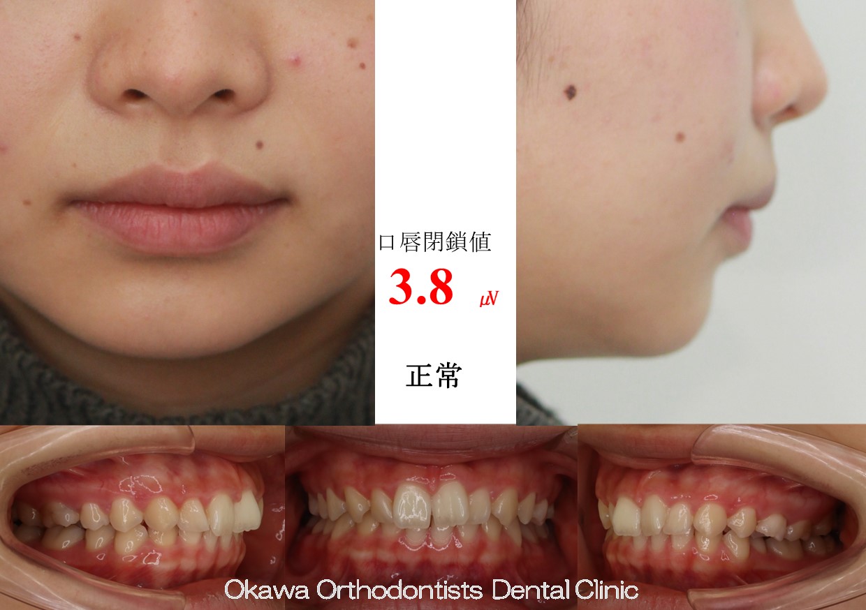 613. 片顎抜歯の Before 画像