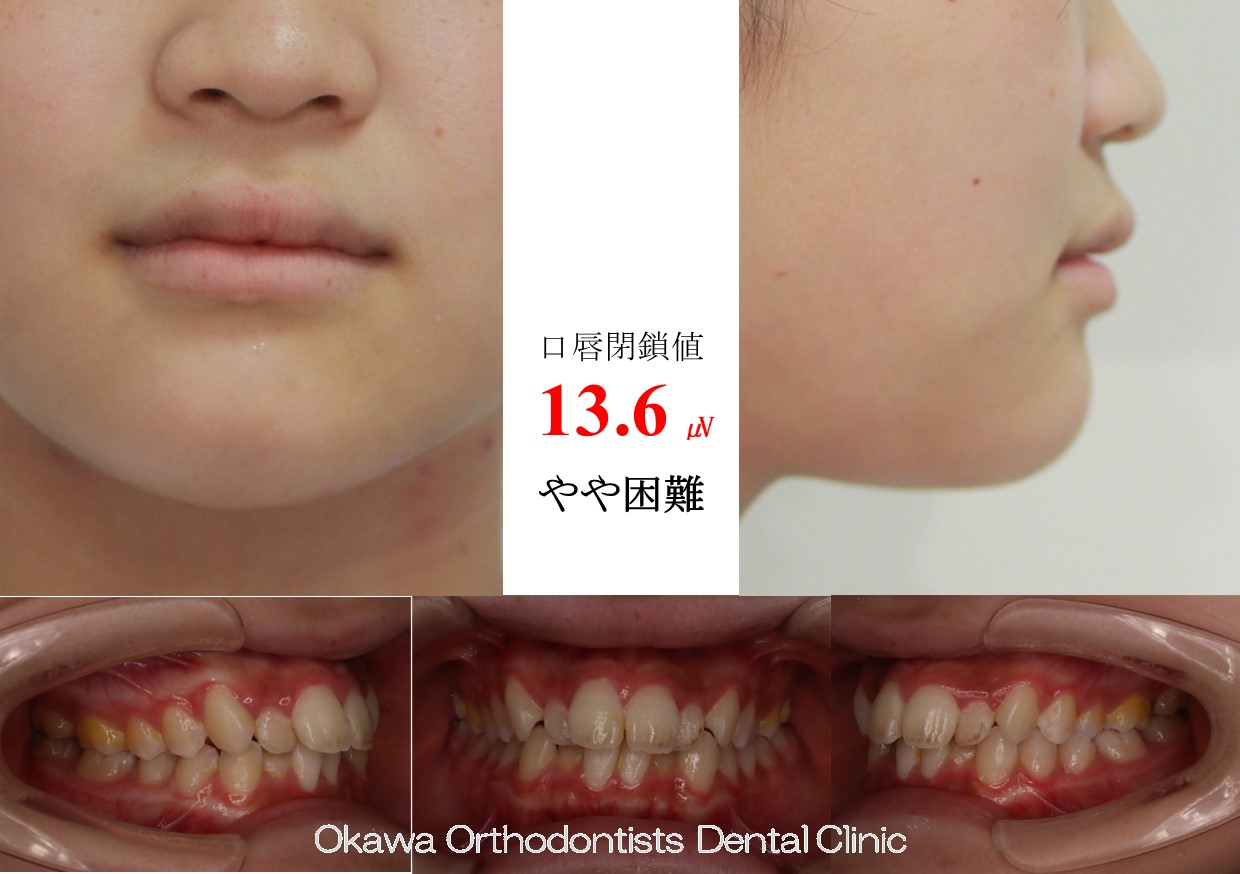 614. 叢生の抜歯ケースの Before 画像