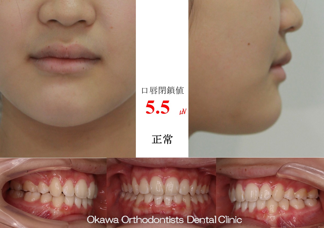 614. 叢生の抜歯ケースの After 画像
