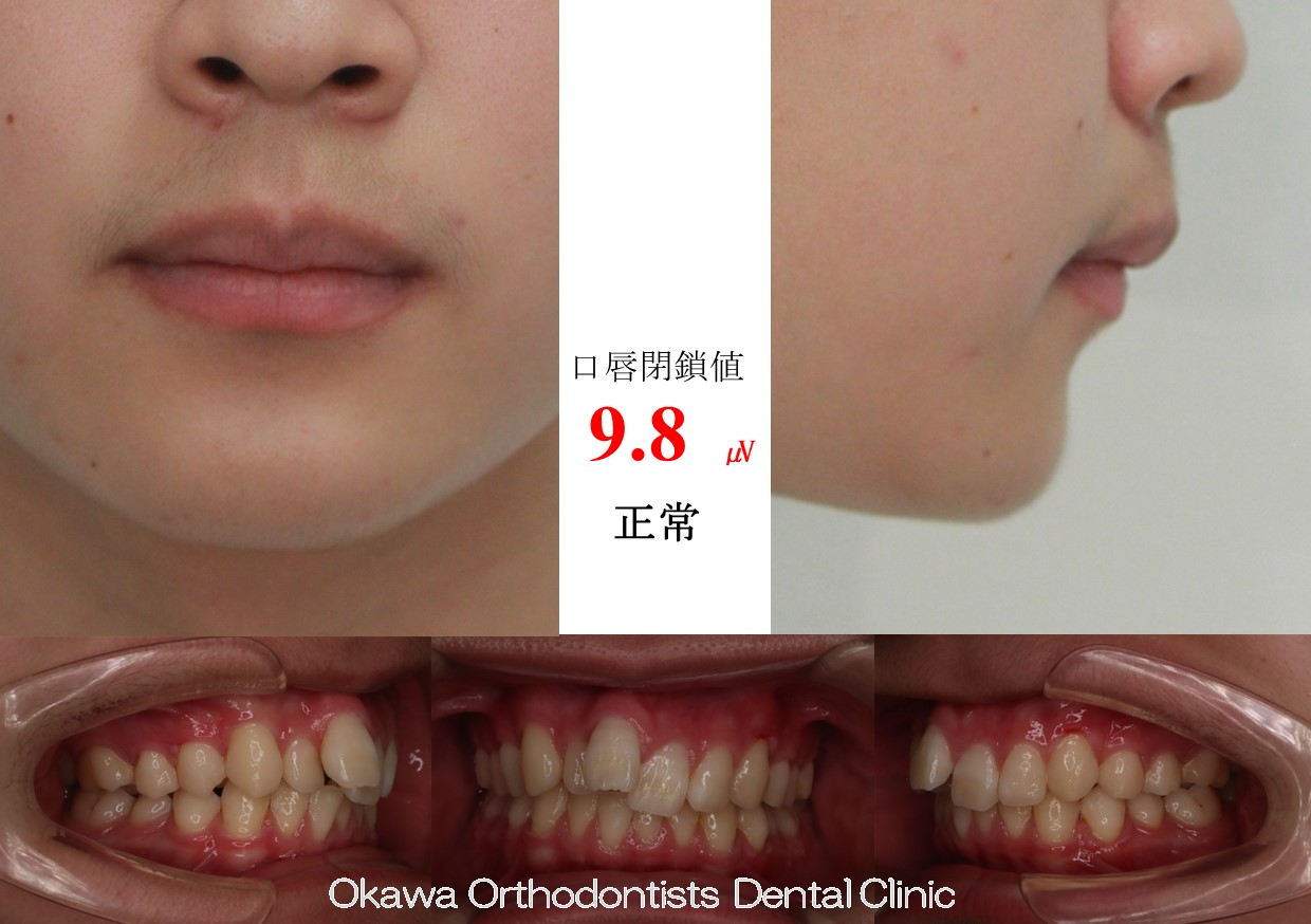 609. 埋伏過剰歯2歯の Before 画像