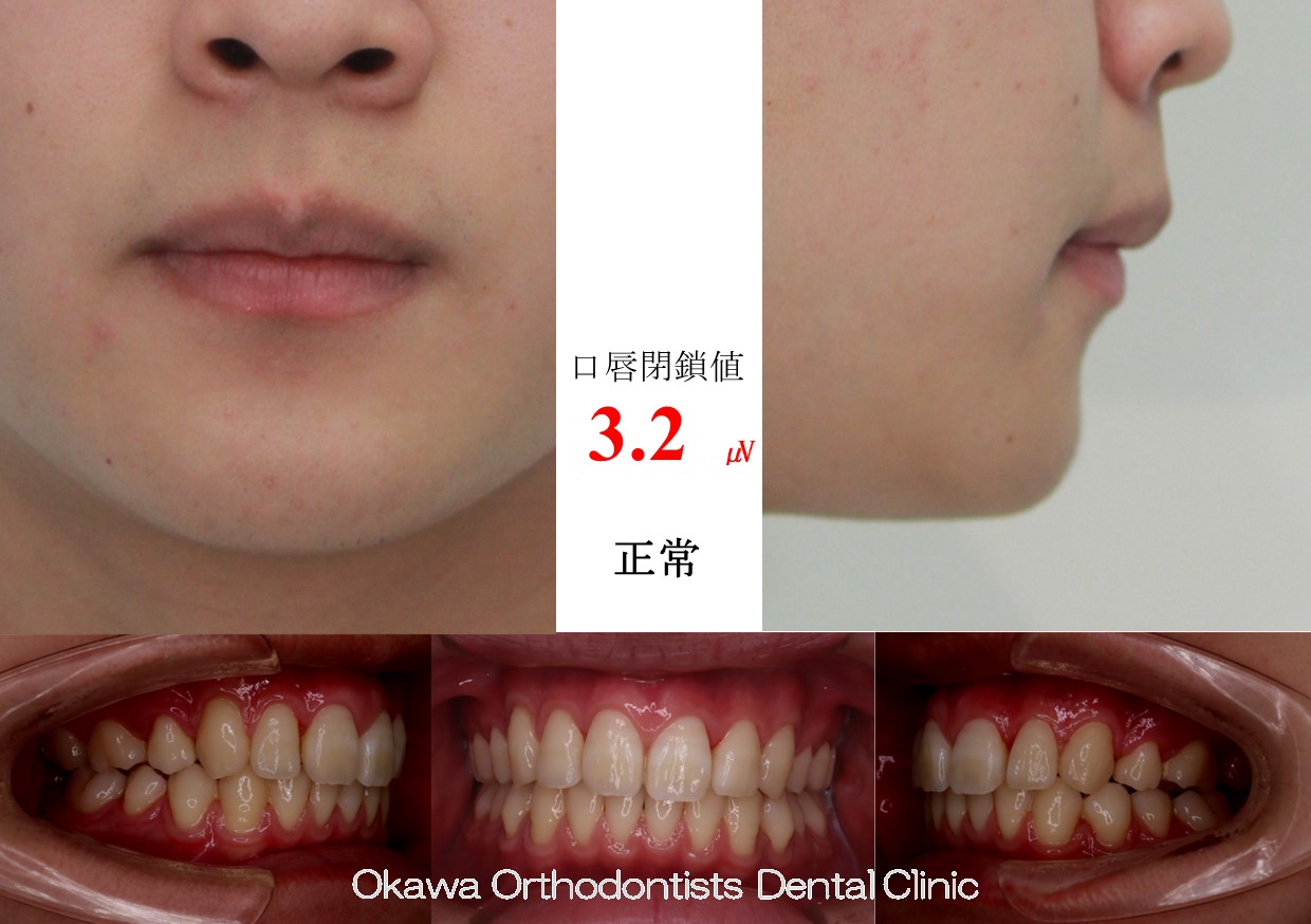 609. 埋伏過剰歯2歯の After 画像