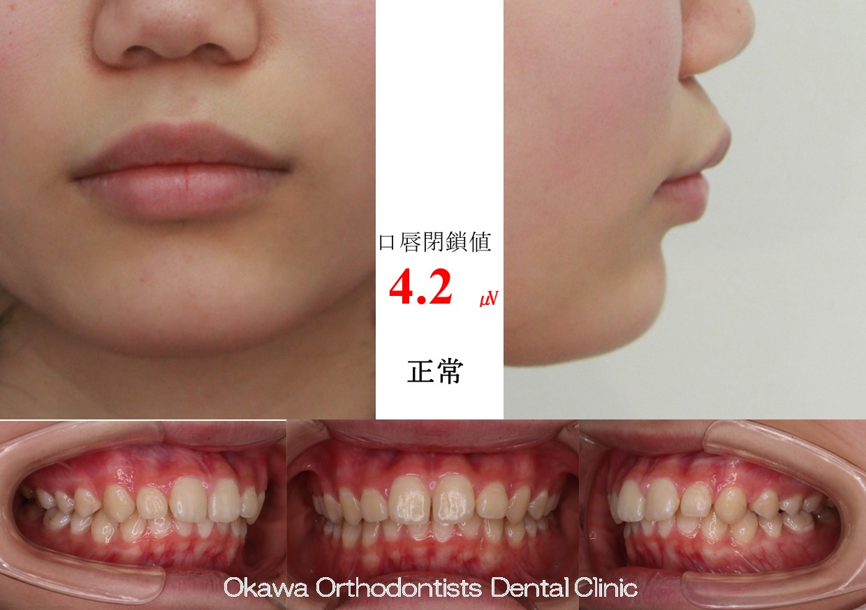 611. 非抜歯で短期間治療の Before 画像