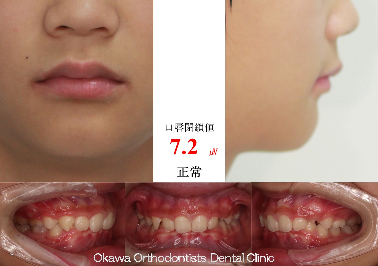 617. バイト挙上に苦労したの Before 画像