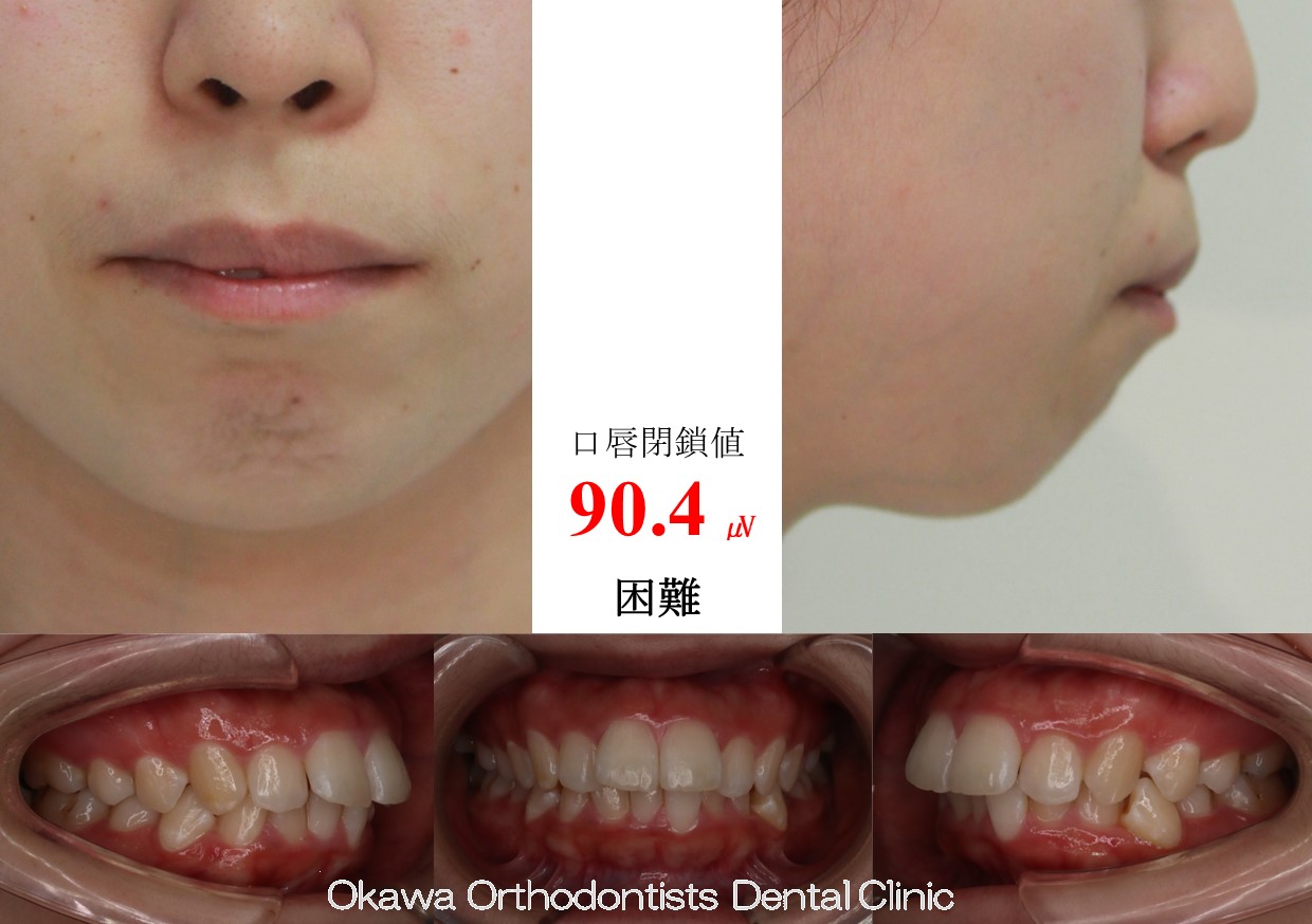 616. 歯が大きいの Before 画像