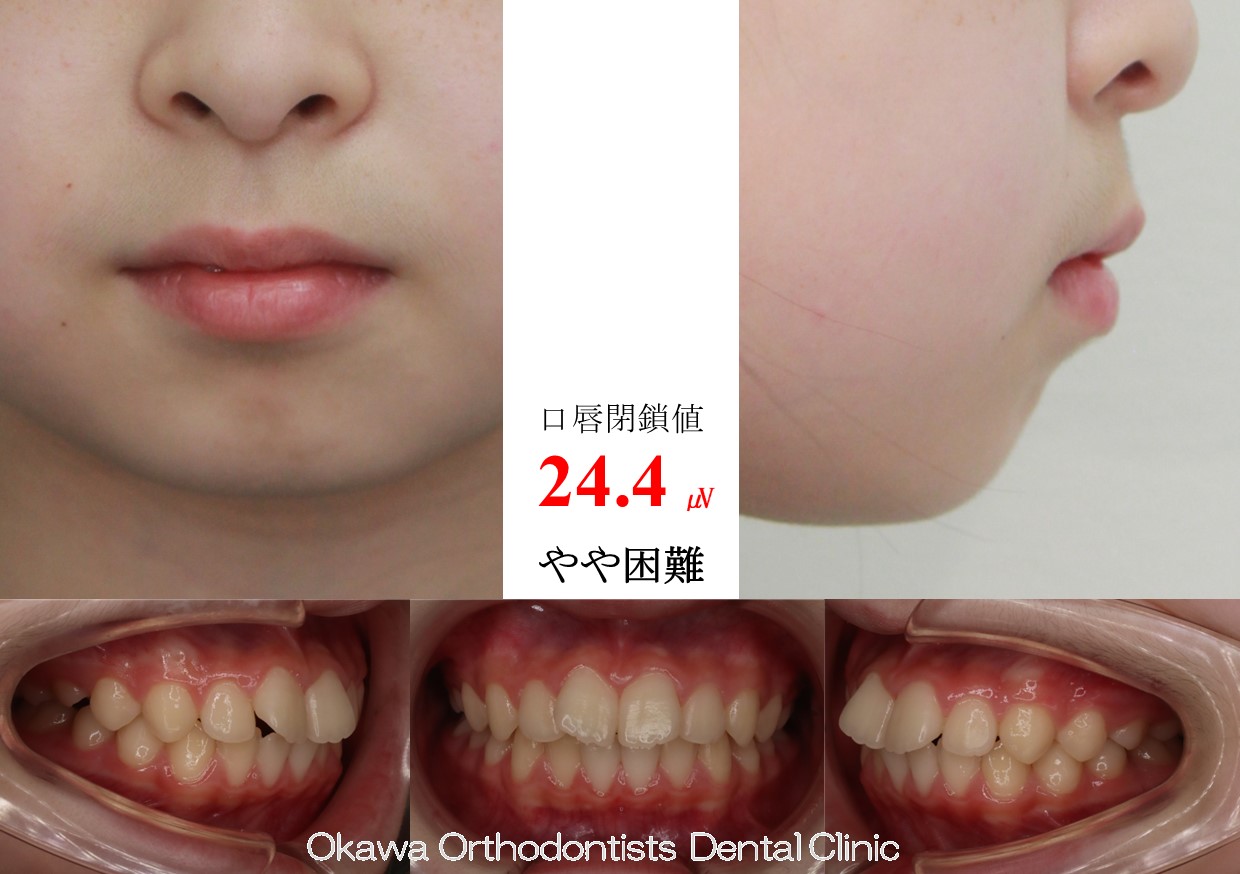 633. 口元が出ている叢生の Before 画像