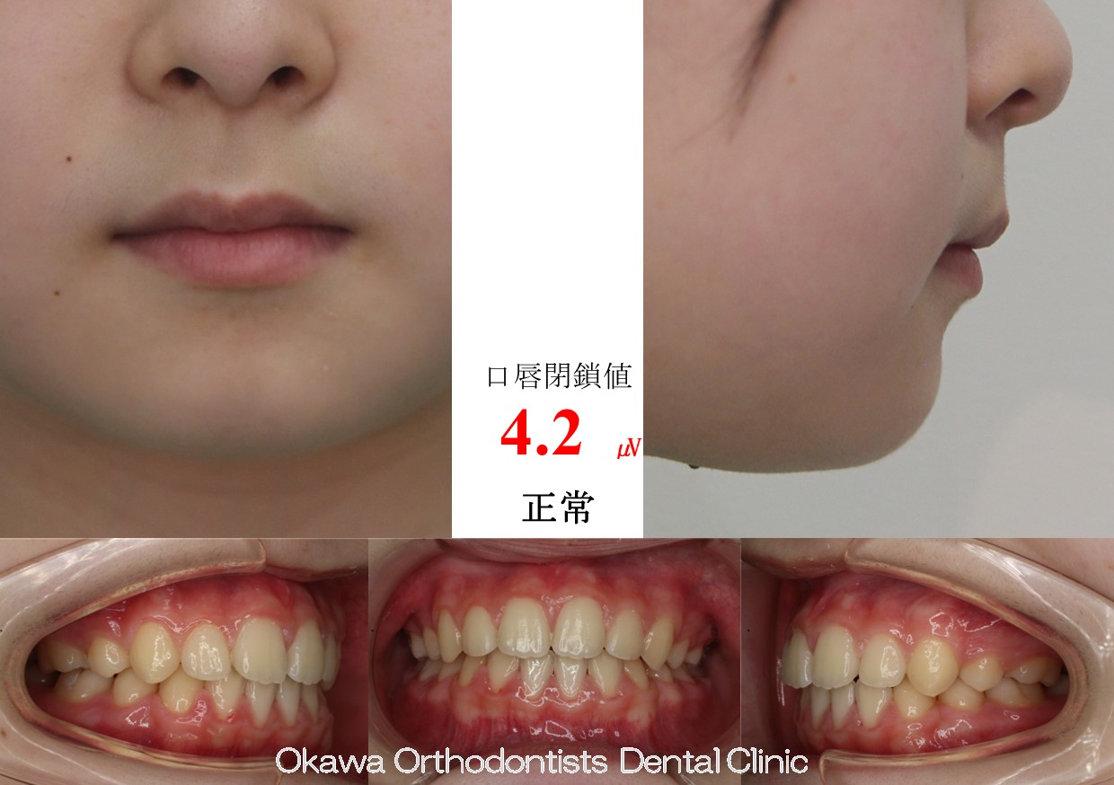 633. 口元が出ている叢生の After 画像