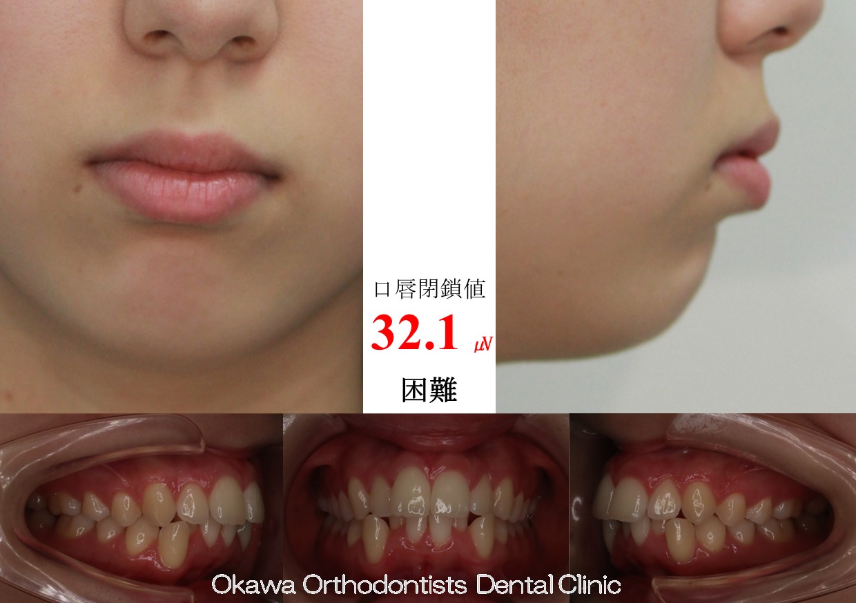 635. 歯列弓が狭いの Before 画像