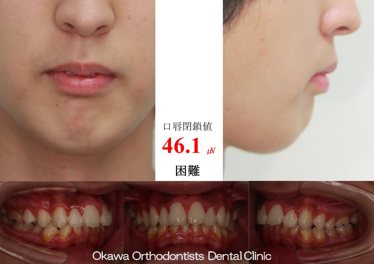640.上顎前突の Before 画像