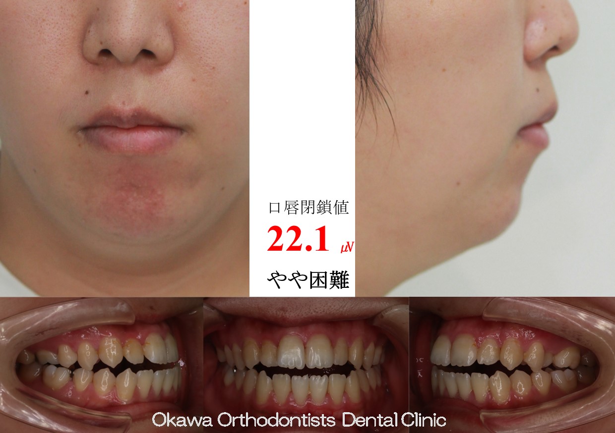 636.中程度の開咬の Before 画像