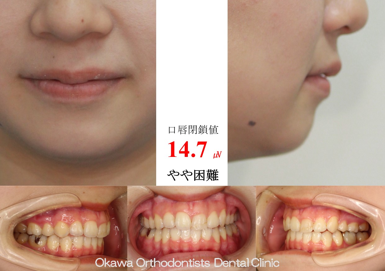 646. 上顎前突・口唇閉鎖不全の After 画像