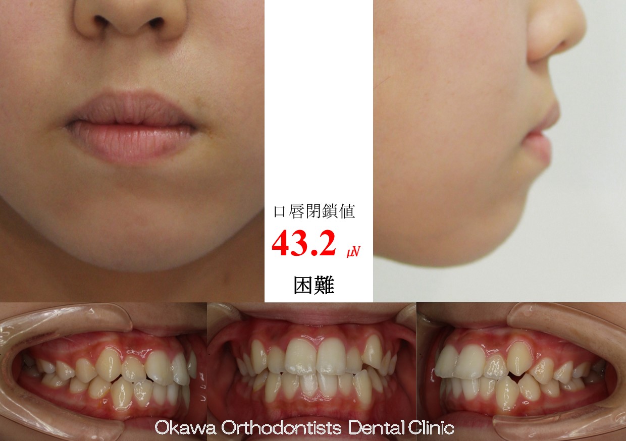 647. 叢生・口唇閉鎖不全の Before 画像