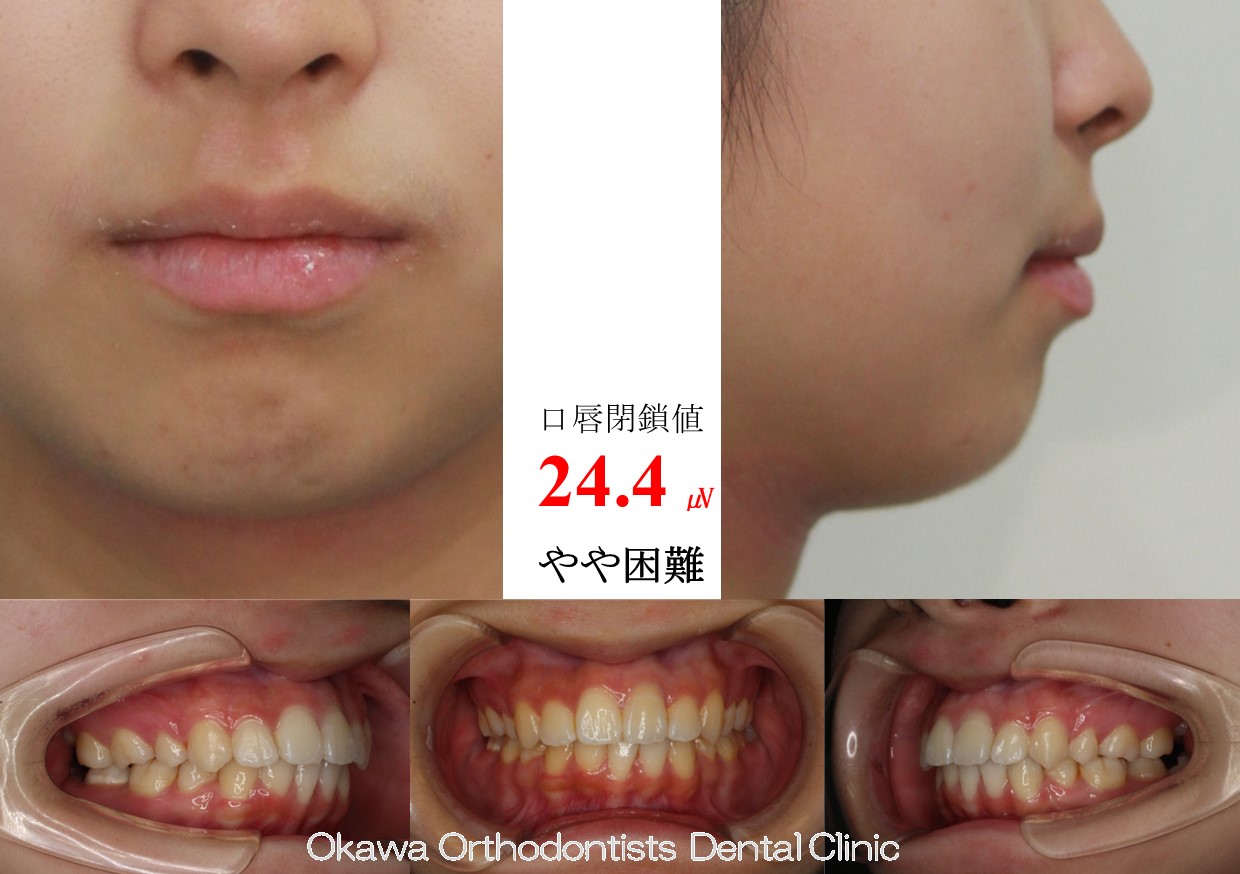 652. 口元を後退させたの After 画像