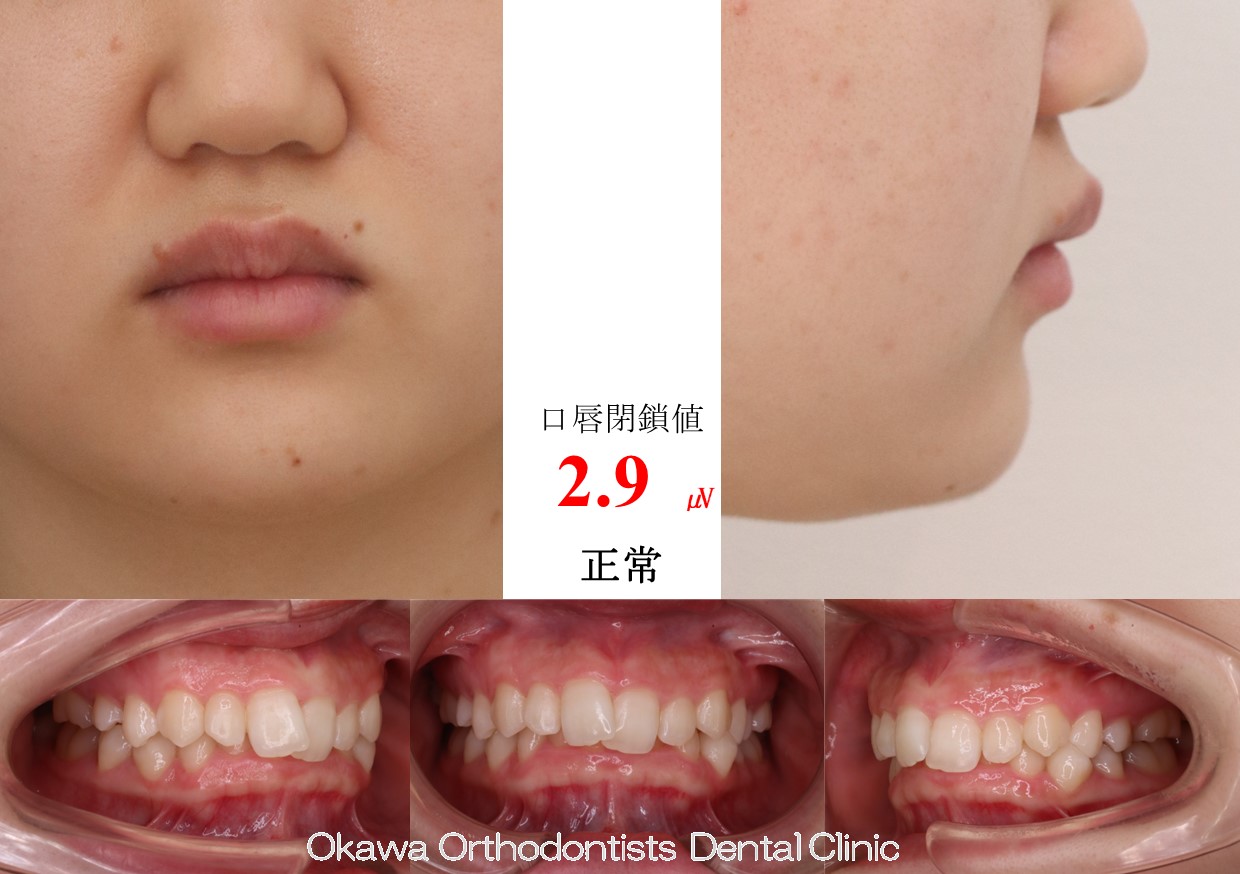 658. 様子をみながら非抜歯にの Before 画像