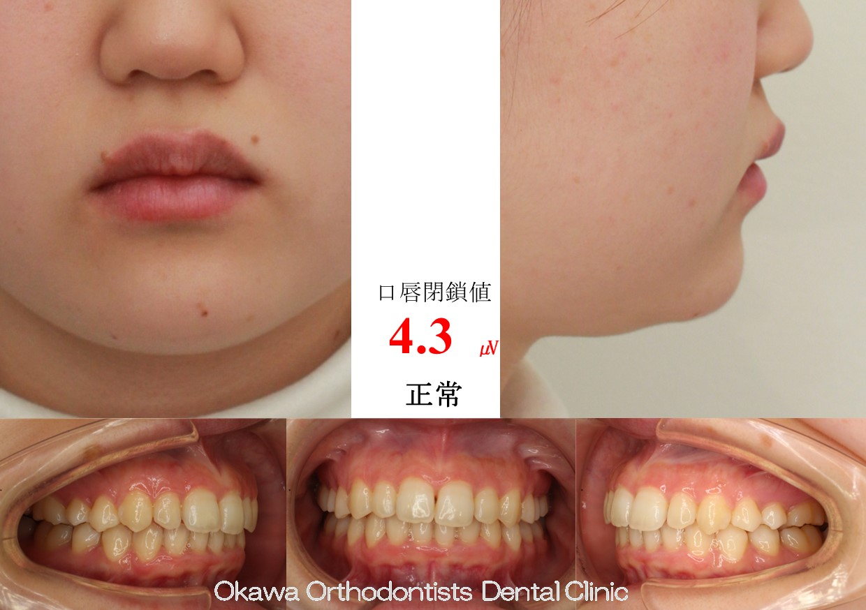 658. 様子をみながら非抜歯にの After 画像