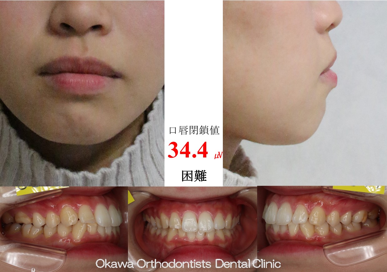 656. 上下顎前突が改善の Before 画像