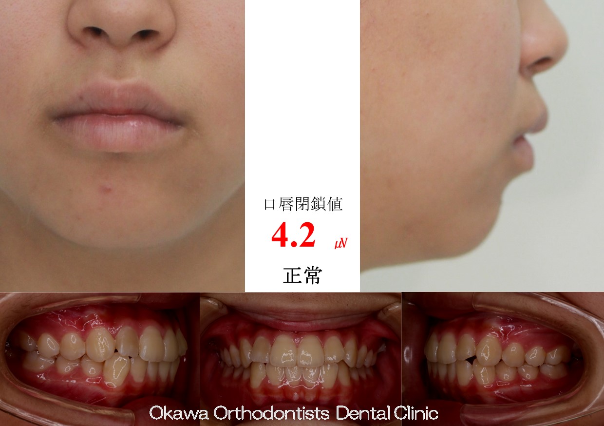 664. 見えない部分の鋏状咬合が主訴の Before 画像