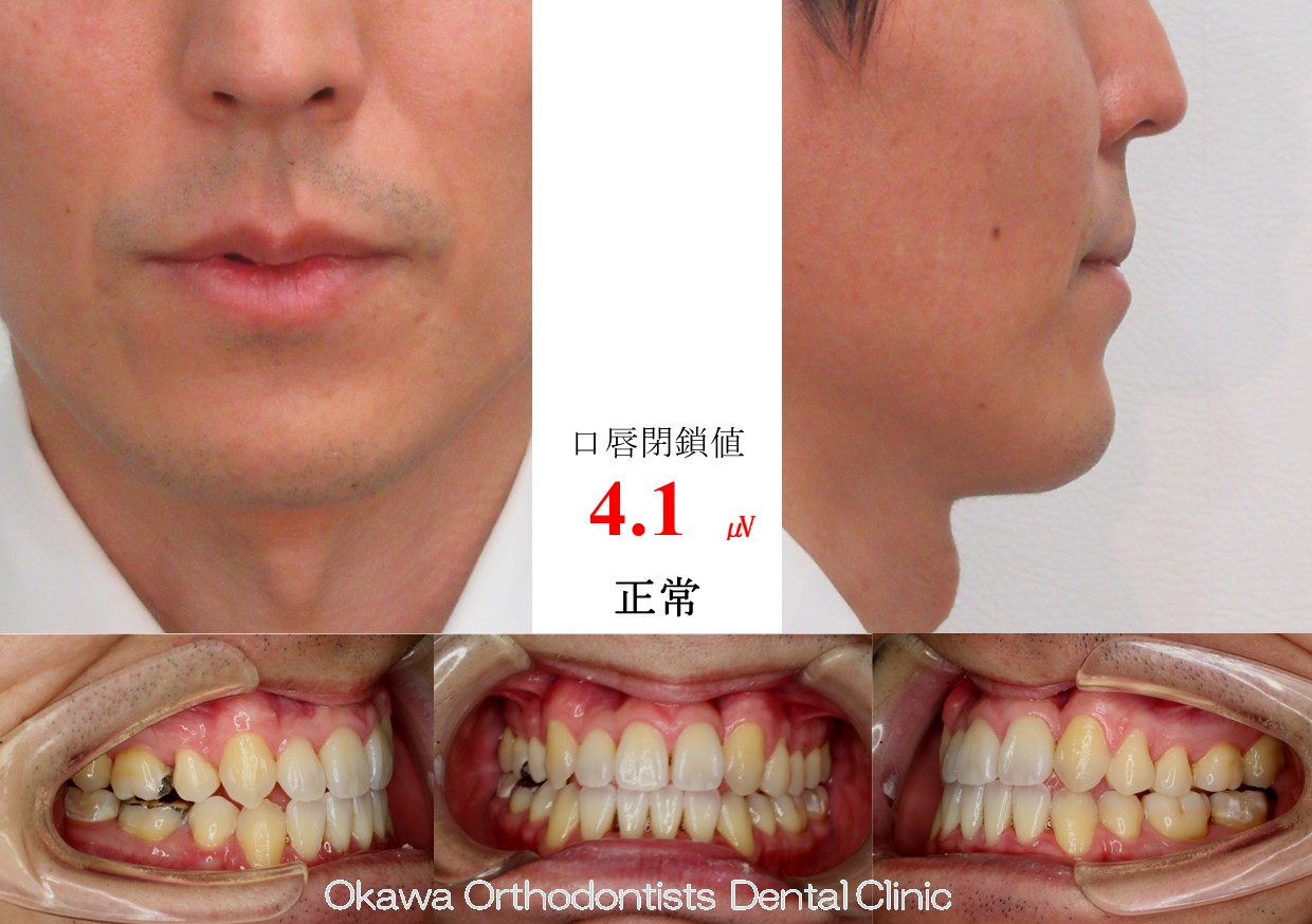 671. 口蓋側転位の側切歯を抜いたの After 画像