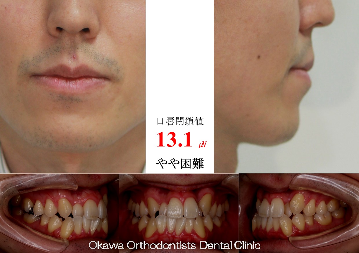 671. 口蓋側転位の側切歯を抜いたの Before 画像