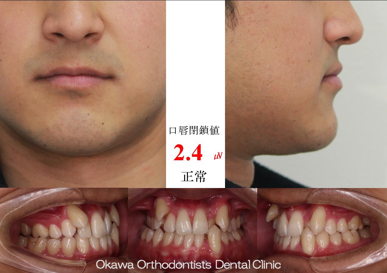 678. 側切歯の被蓋改善が難しかったの Before 画像