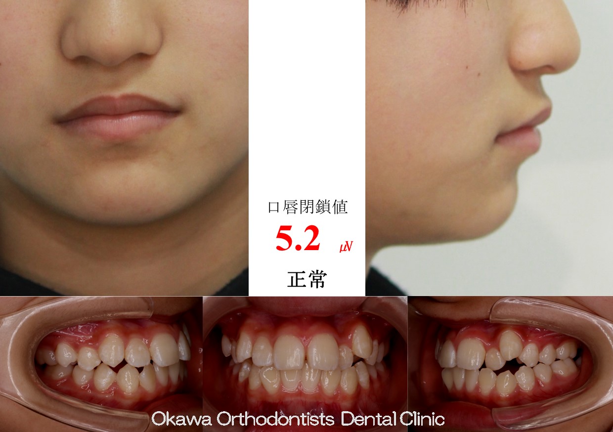 675. 歯磨きが悪く白濁の Before 画像