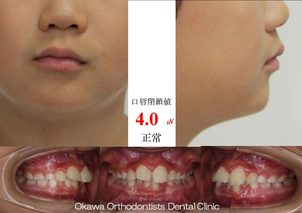 683. 年齢の割に期間がかかったの Before 画像