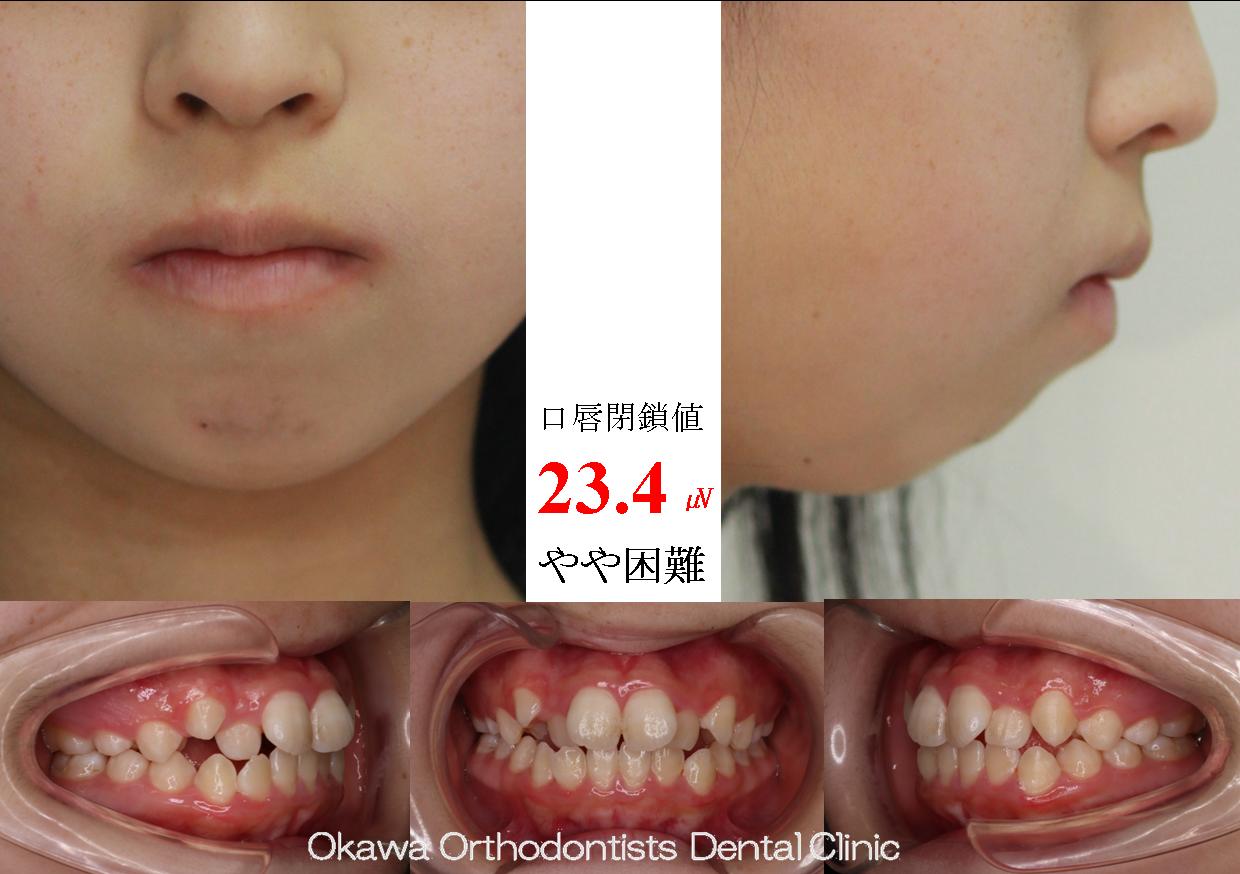 686. 舌癖で期間が延びたの Before 画像