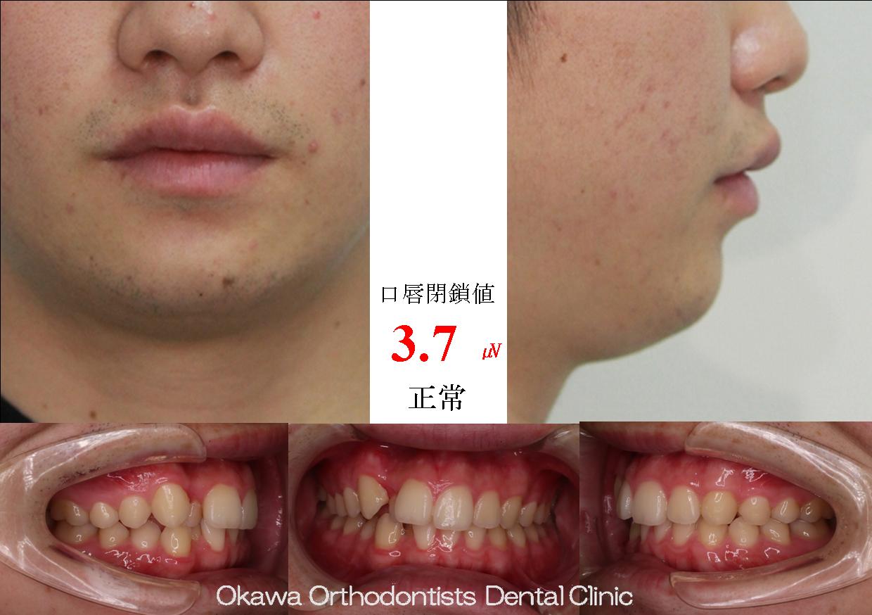 682. 側方拡大で非抜歯の Before 画像