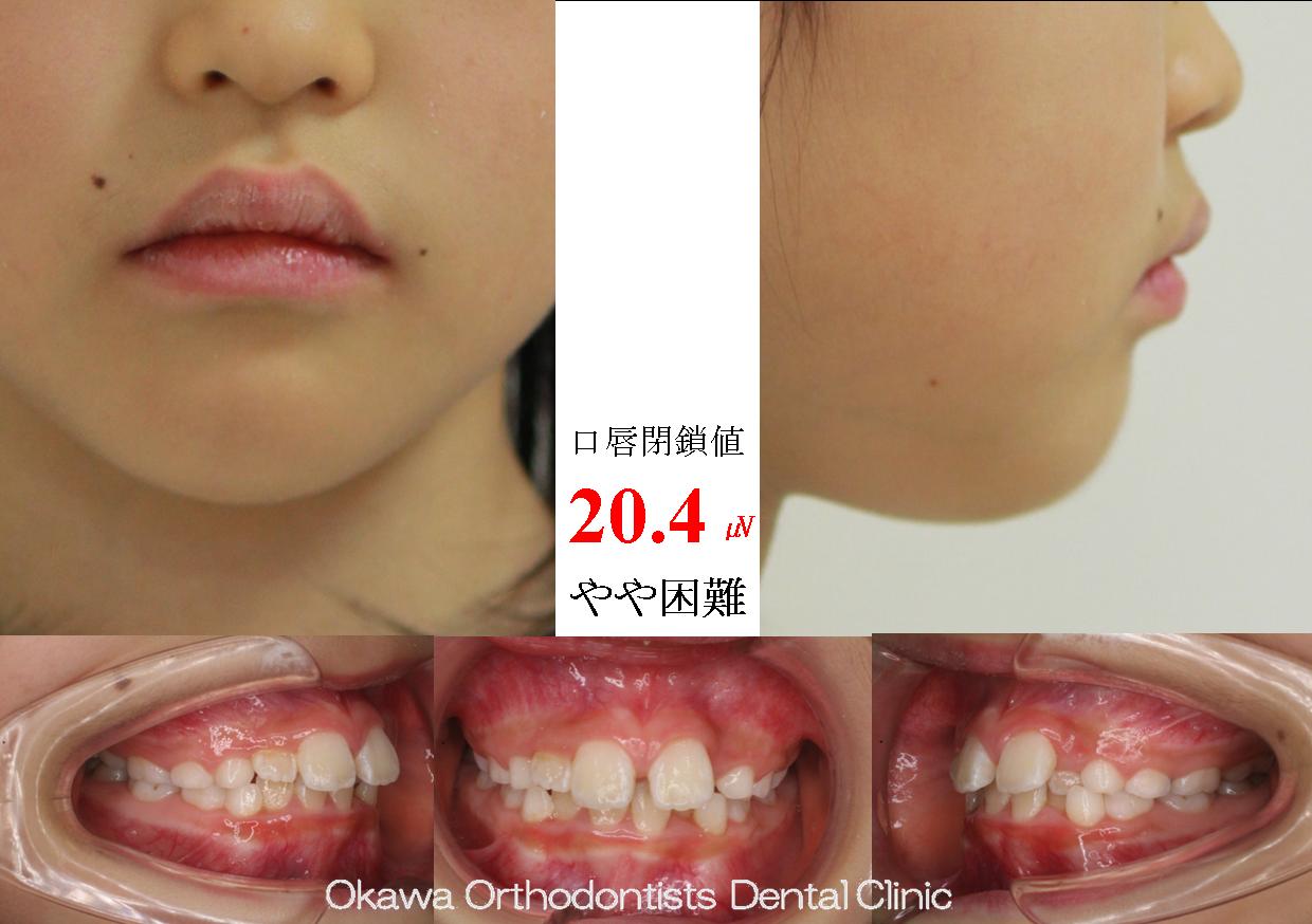 693. 非抜歯でⅡ期治療の Before 画像