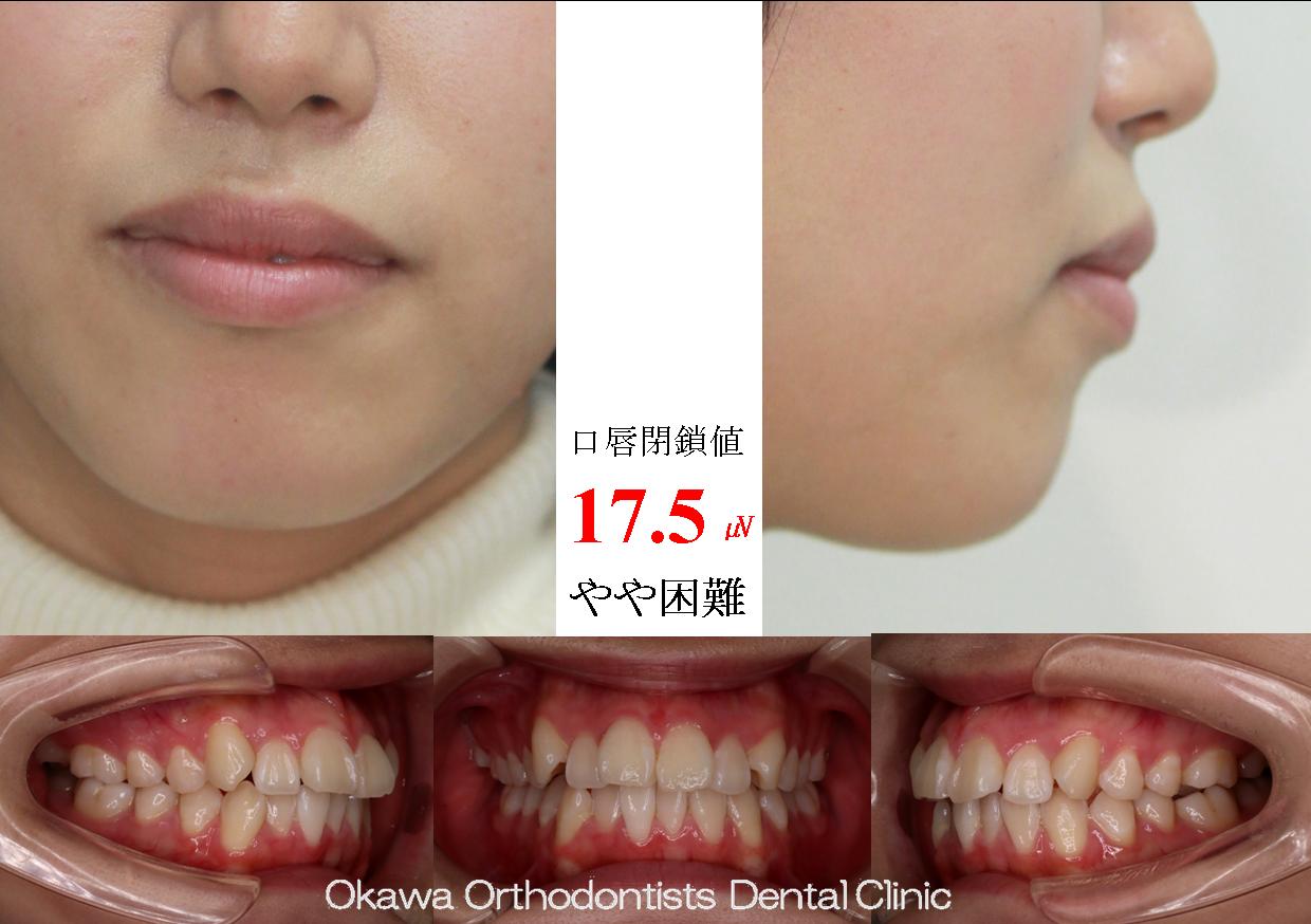 704. 鋏状咬合の治療が長かったの Before 画像