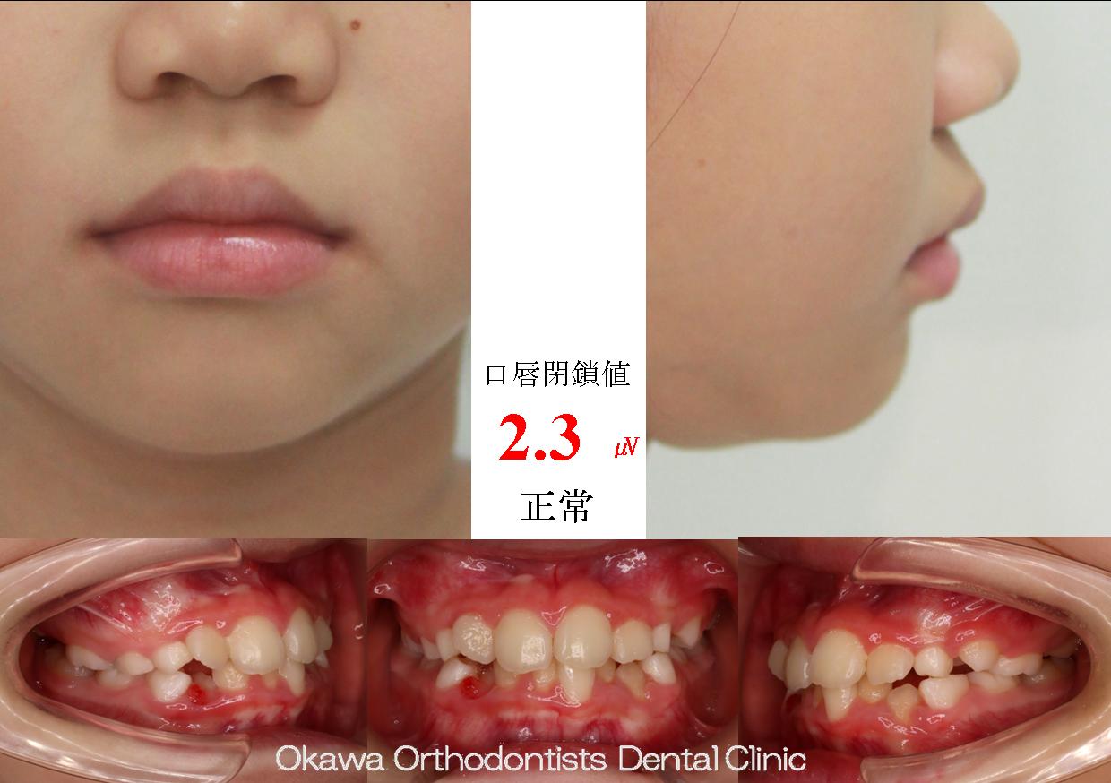 711. 上顎６の傾斜埋伏から始まるの Before 画像