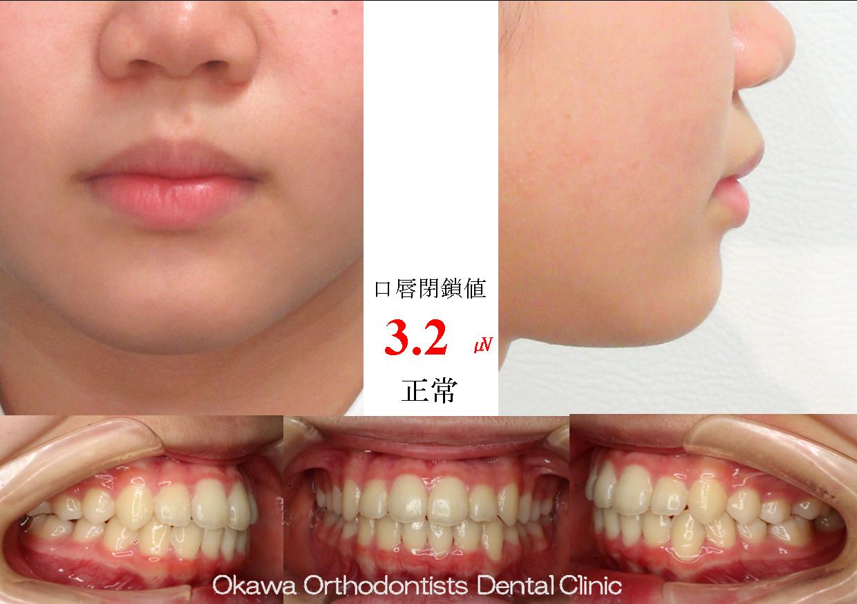 711. 上顎６の傾斜埋伏から始まるの After 画像