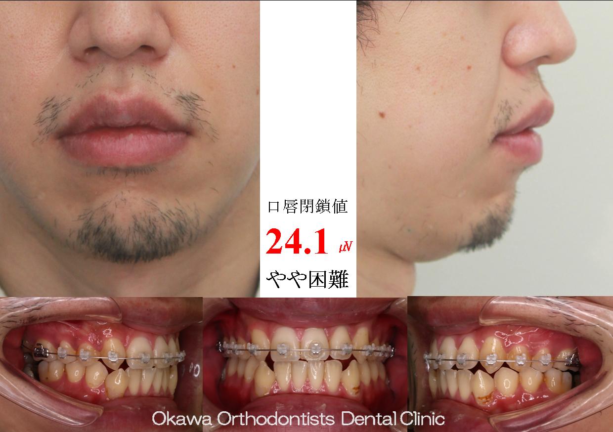 712. 下顎両側７の近心傾斜埋伏の Before 画像