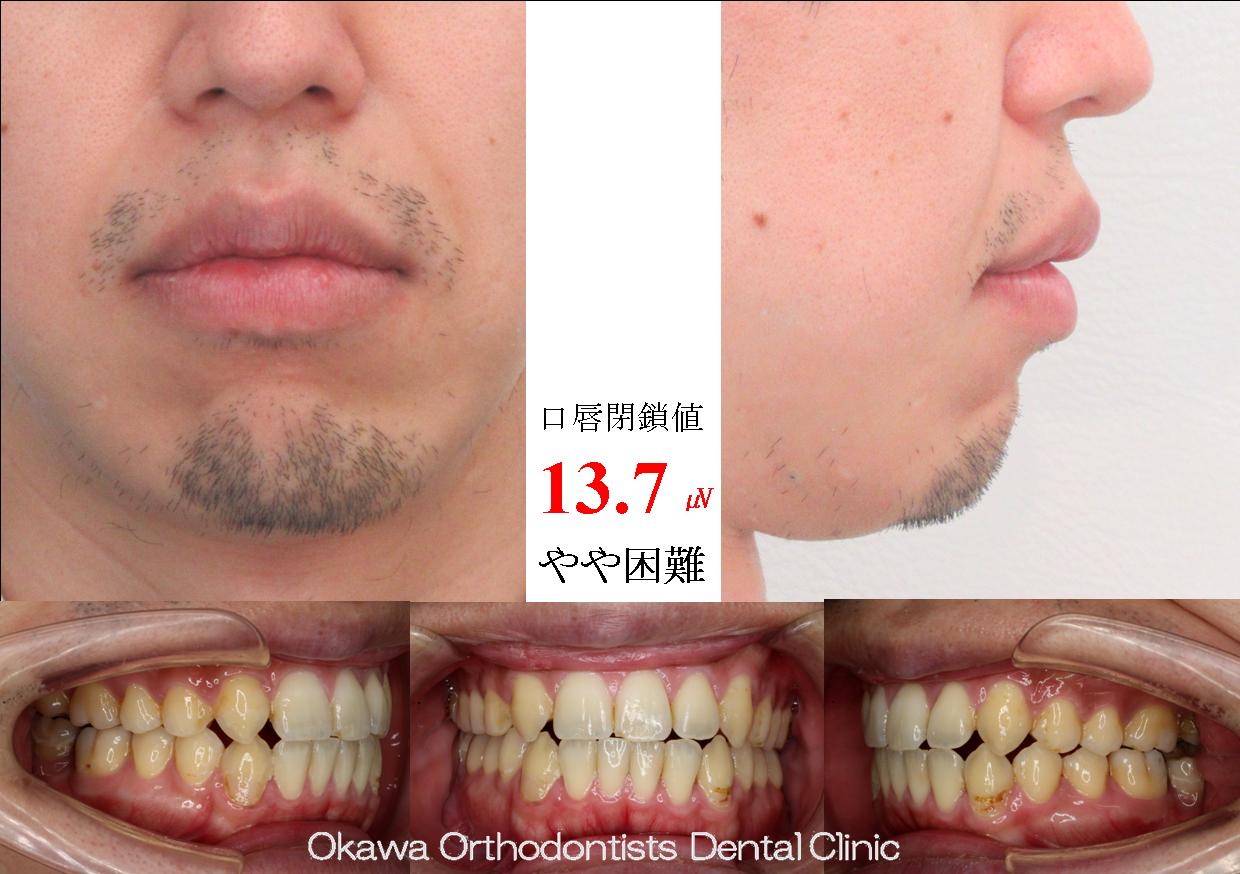 712. 下顎両側７の近心傾斜埋伏の After 画像