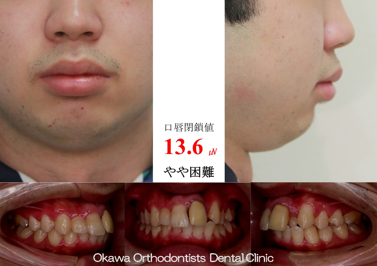 719. 上顎前歯が継続歯の Before 画像