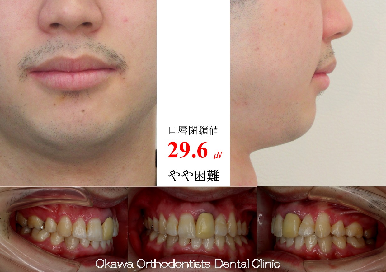 719. 上顎前歯が継続歯の After 画像