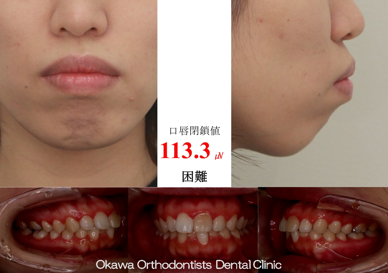 723. とても厳しいBimaxの Before 画像