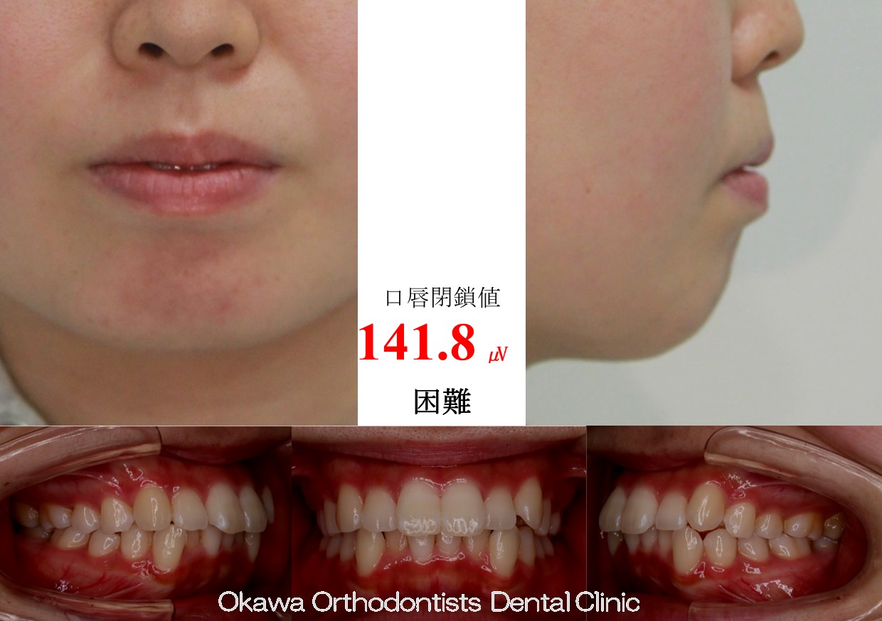727. 口唇閉鎖不全が改善の Before 画像