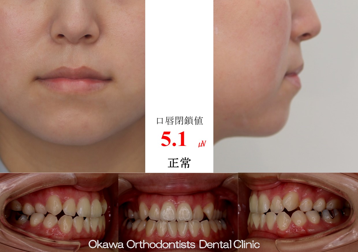 726. 非抜歯だったが期間がかかったの Before 画像